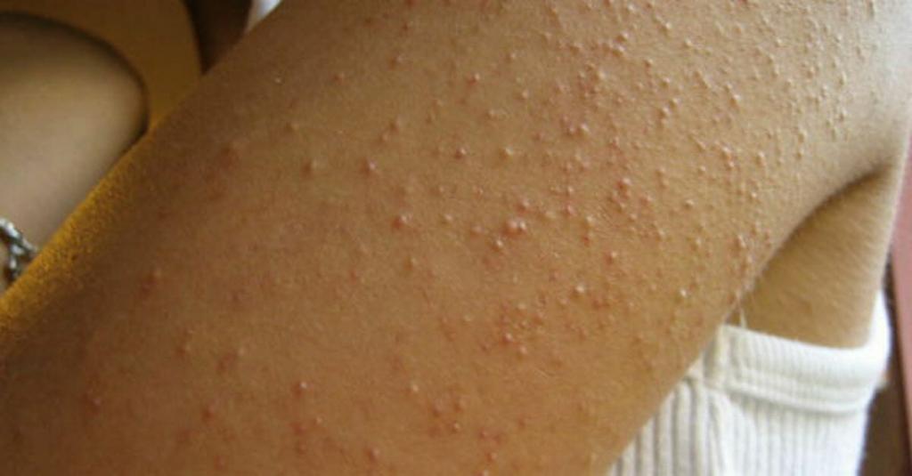 аллергия на глютен симптомы у взрослых