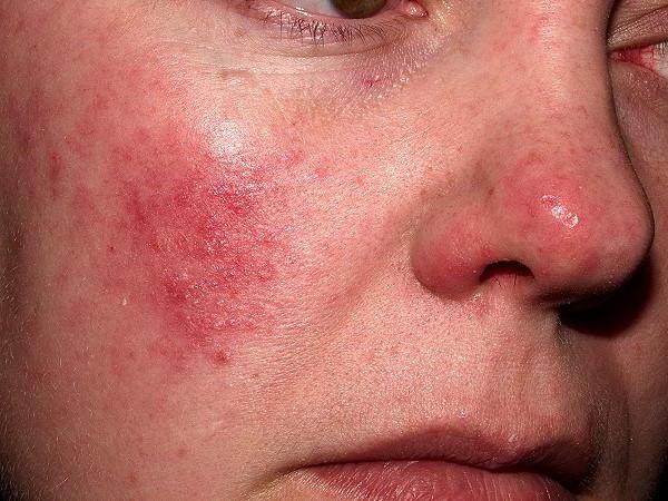 аллергический дерматит симптомы и лечение у взрослых
