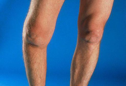 чем отличается артрит от артроза коленного сустава