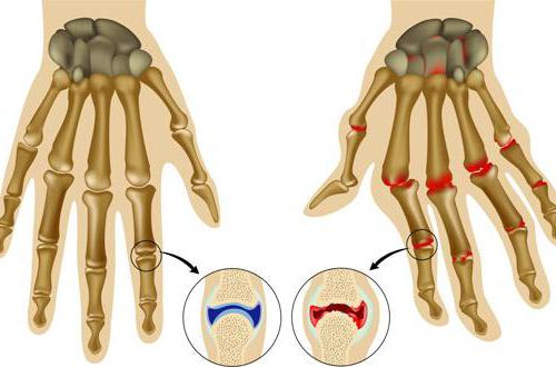 артрит пальцев рук симптомы