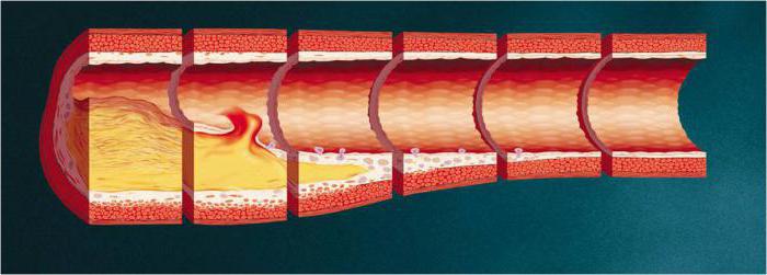 атеросклеротическая бляшка в сонной артерии лечение