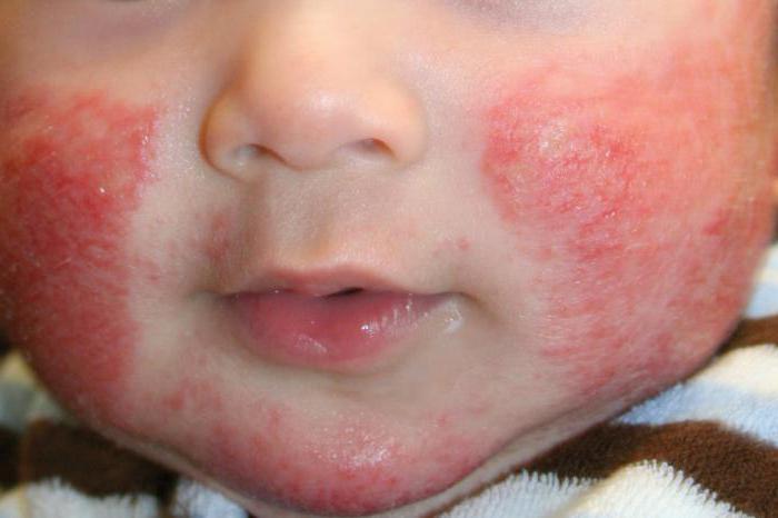 питание ребенка при атопическом дерматите