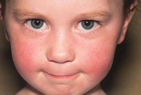 вирусный дерматит у детей