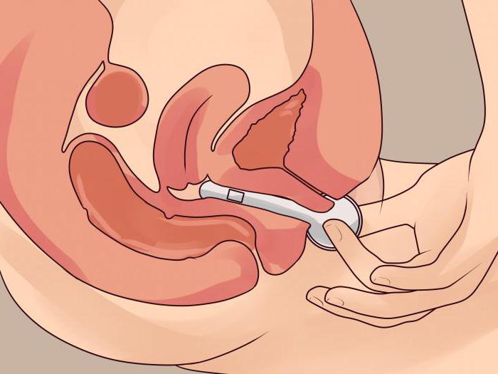 симптомы и лечение бактериальный вагиноз