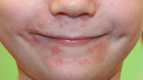 себорейный дерматит на лице симптомы 