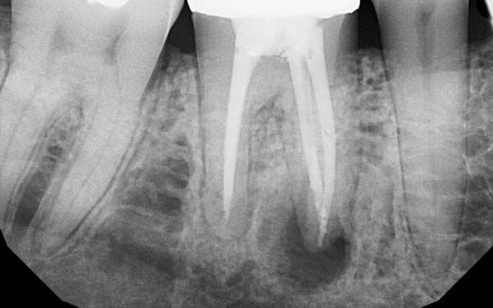  гранулема зуба лечение зуба