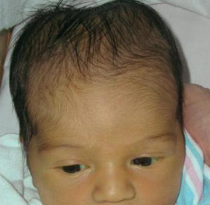 гематома после родов у ребенка на голове 