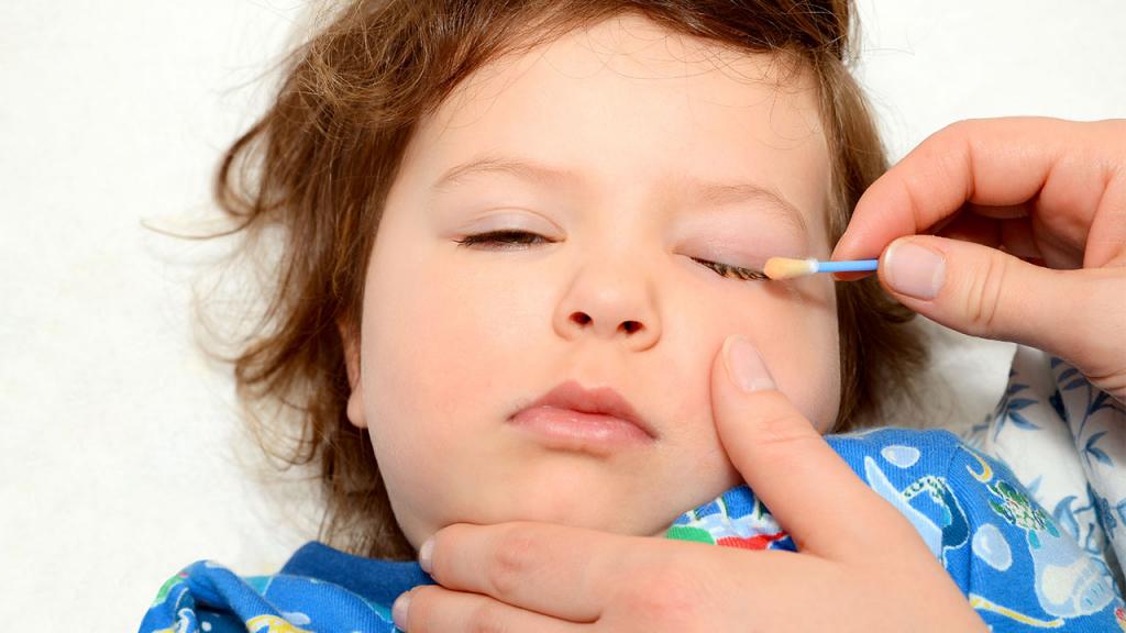 Как промывать глаза ребенку при конъюнктивите?