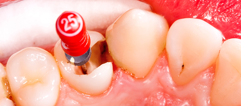 Воспаление корня зуба симптомы