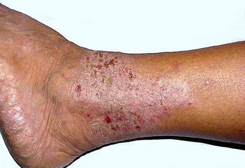 венозный дерматит на ногах симптомы