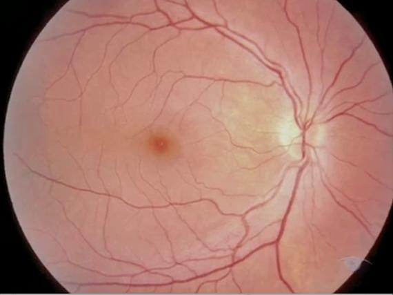 Глазное дно при офтальмоскопии