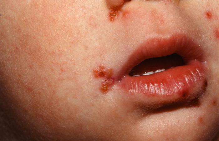 стафилококковый дерматит у детей что делать