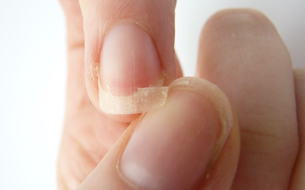 Дистрофия ногтевой пластины онихошизис