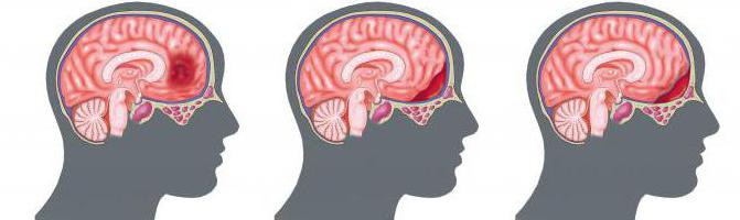 Виды гематом головного мозга