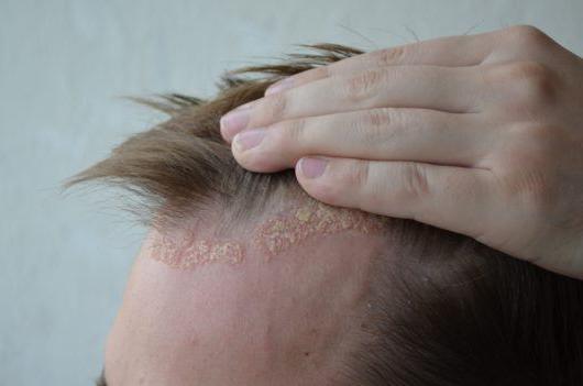 себорейный дерматит волосистой части 
