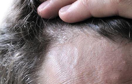 себорейный дерматит волосистой части головы народными средствами 