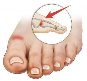 артрит лечение пальцев ног 