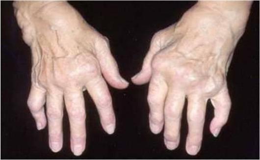 артрит пальцев рук