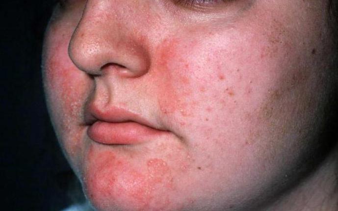 себорейный дерматит лечение на лице лечение 