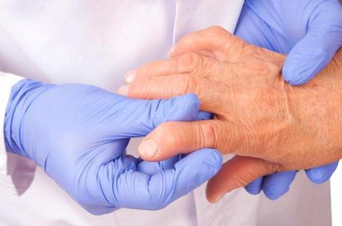 как вылечить артрит на пальцах рук