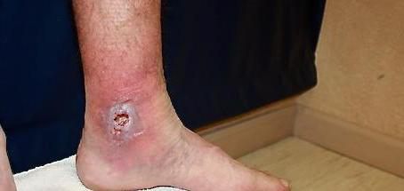 венозный дерматит на ногах лечение