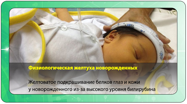 Физиологическая желтуха у новорожденных сколько. Физиологическая желтуха новорожденных. Желтушка у новорожденных. Физиологическая желтушка у новорожденного. Физиологическая желтуха новорожденных фото.