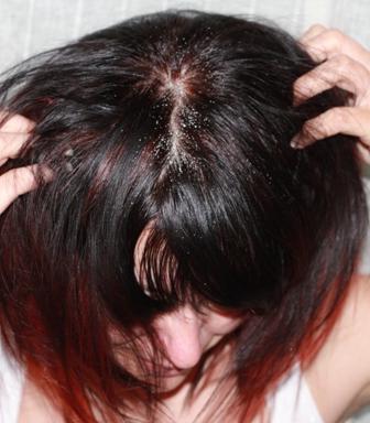 лечение себорейного дерматита волосистой части 
