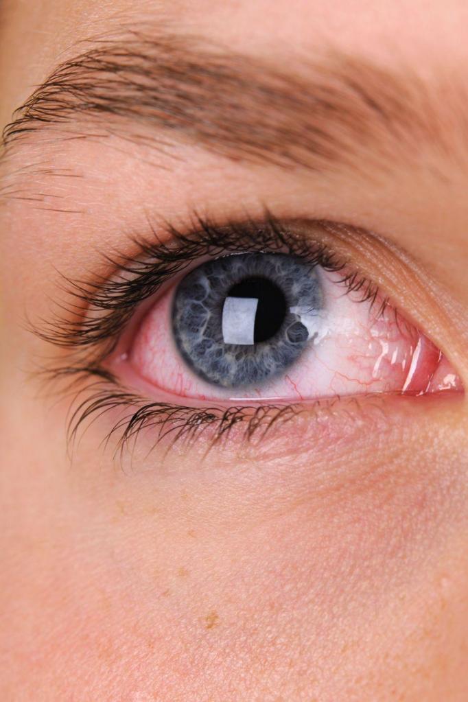 Симптомы глазного давления