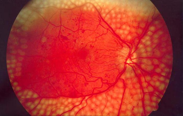 диабетическая ретинопатия что это такое