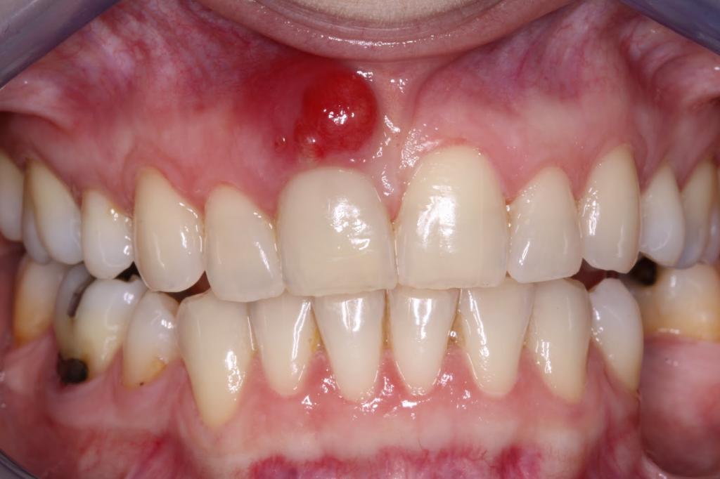 Воспаление корня зуба лечение