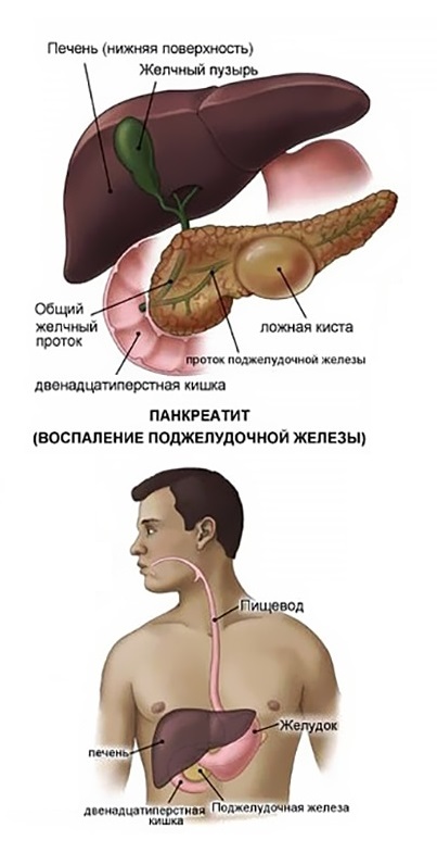 Симптомы панкреатита у мужчин