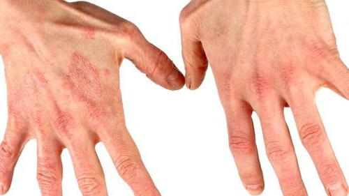экзематозный дерматит на руках