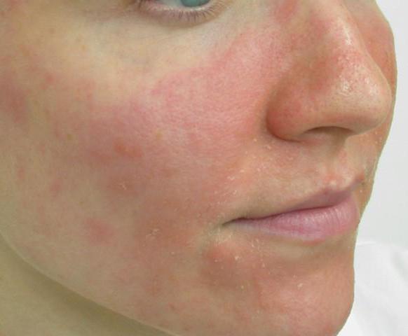 аллергический дерматит на лице