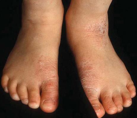 дерматит на ногах лечение мази