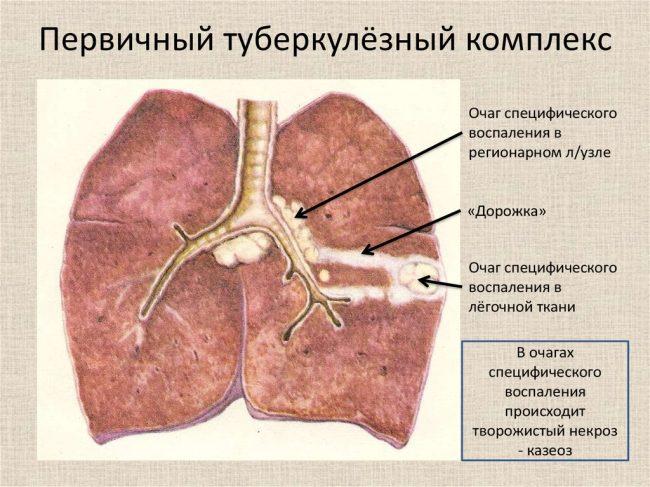 первичный туберкулез 