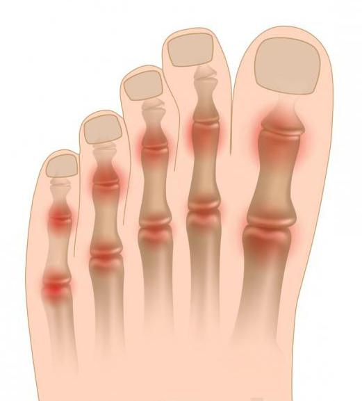артрит большого пальца ноги лечение