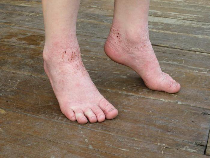 как лечить дерматит на ногах отзывы
