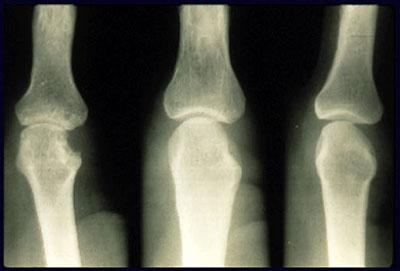 рентген стадии и признаки ревматоидного артрита ра 
