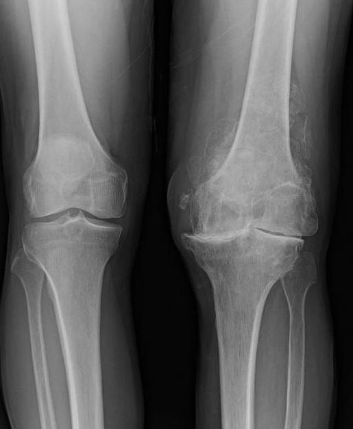 подагрический артрит коленного сустава рентген 
