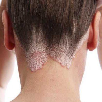 себорейный дерматит волосистой части головы 