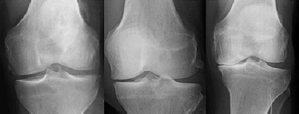 лечение артрита коленного сустава в домашних условиях