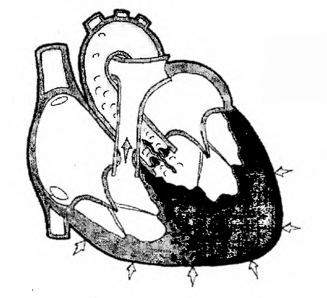 Митральный аортальный стеноз. Аортальный и митральный стеноз. Стеноз аортального клапана. Стеноз устья аорты на УЗИ.