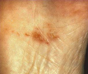 аллергический дерматит на ногах
