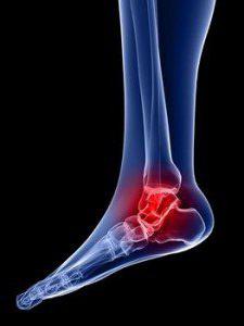 артрит или воспаление суставов на ногах лечение