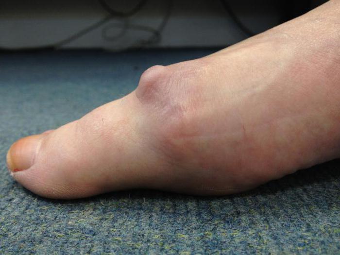 артрит пальцев ног симптомы и лечение