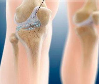 подагрический артрит коленного сустава симптомы и лечение